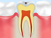 【CO】ごく初期段階の虫歯