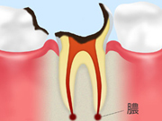 【C4】歯の大部分が溶けてしまっている虫歯